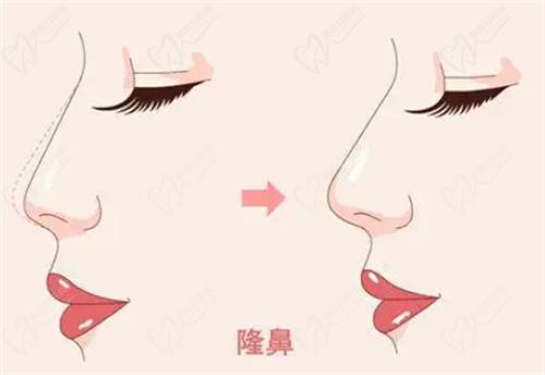 毛運(yùn)春醫(yī)生做鼻子怎么樣？
