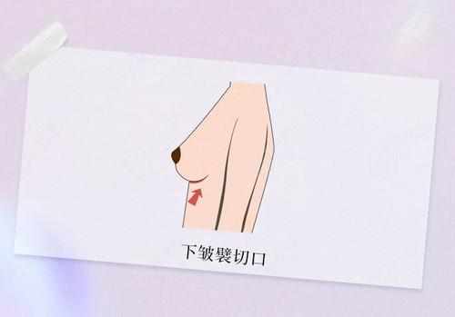四川現(xiàn)代醫(yī)院李獻和醫(yī)生的隆胸技術高超