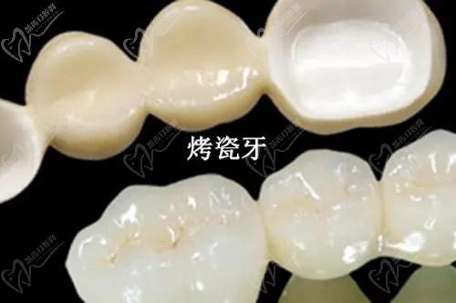 各地區(qū)牙齒貼面多少錢？2025價格表：